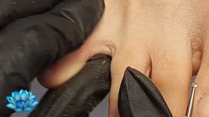 Стержневая мозоль между пальцами. Как лечить?