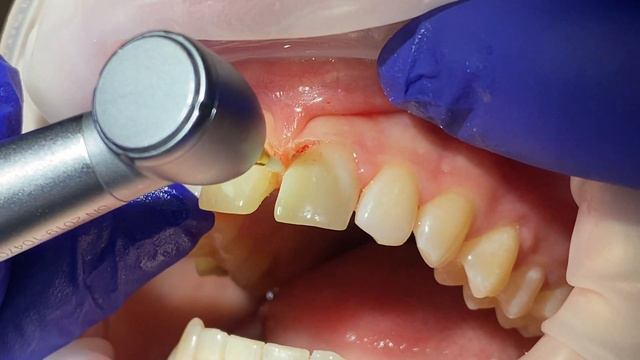 Пластика десны бором