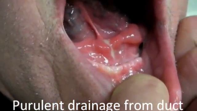 Really BIG Salivary Gland Stones смотреть онлайн