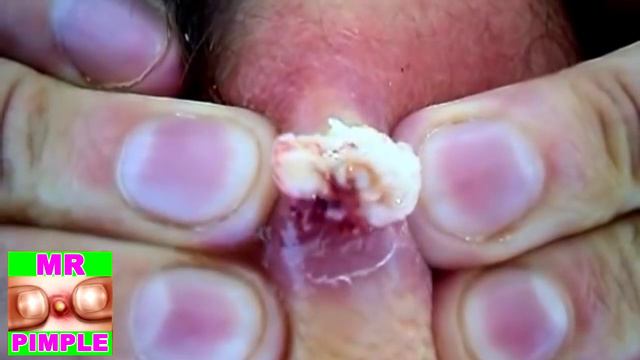 Big Pimple Coming Out Of The Body - Mr. Pimple