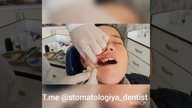 Удаление корня зуба смотреть онлайн