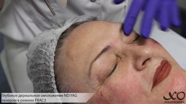 Лазерные методики в клинике ХО лаборатория. Аппарат Fotona. Часть 1 смотреть онлайн