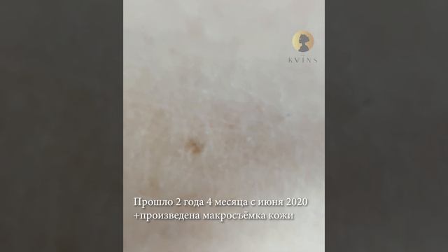 Центр лазерной эпиляции Квинс kvvins.ru t.me/kvvins смотреть онлайн