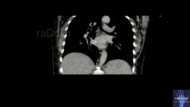Mediastinal Lymphnodal Stations on Chest CT scan смотреть онлайн