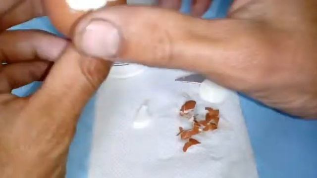 Как вывести опарышь из вареного яйца смотреть онлайн