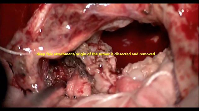 LARGE PARIETO-OCCIPETAL FALX MENINGIOMA-microsurgery/dr suresh dugani/HUBBALLI/KARNATAKA/INDIA смотреть онлайн