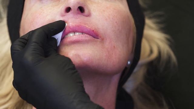 Lip augmentation: Multi product approach by Simon and Emma Ravinchandran смотреть онлайн