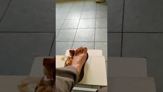 Перевязка после удаления ногтя. смотреть онлайн