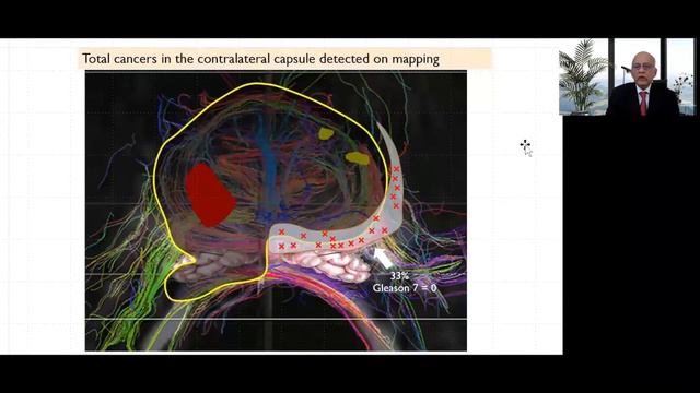 Radical Prostatectomy: Yesterday, Today, Tomorrow смотреть онлайн