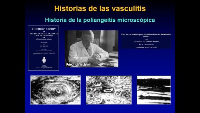 Historia de las Vasculitis Primarias смотреть онлайн