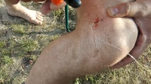 Как достать крючок из ноги часть 2))) смотреть онлайн