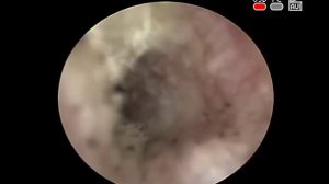 Хронический #грибковый наружный #отит #отомикоз otomycosis отоскопия диагностика лечение