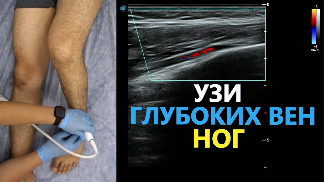 УЗИ Глубоких Вен Нижней Конечности с демонстрацией датчика. Пишем ПРОТОКОЛ вместе.