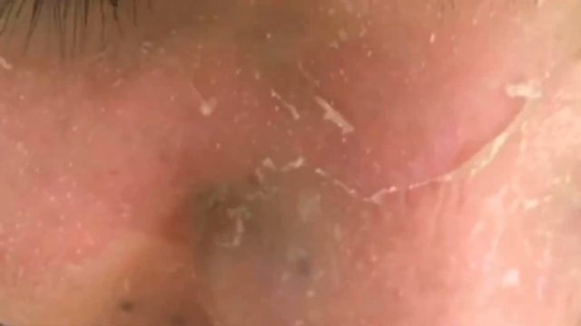 Satisfying Sunburn Skin Peeling ?? смотреть онлайн
