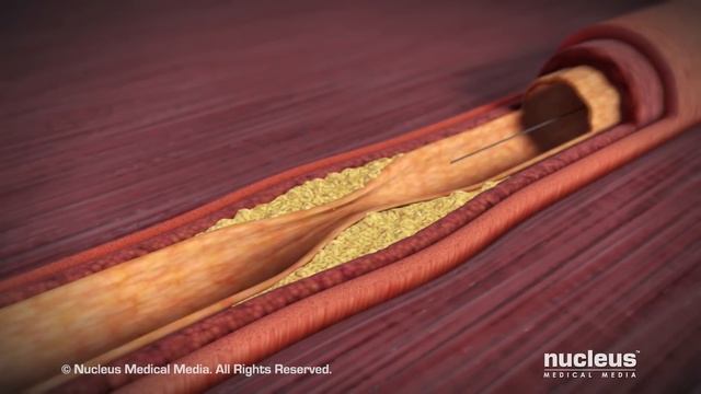 Coronary Angioplasty (Femoral Access) смотреть онлайн