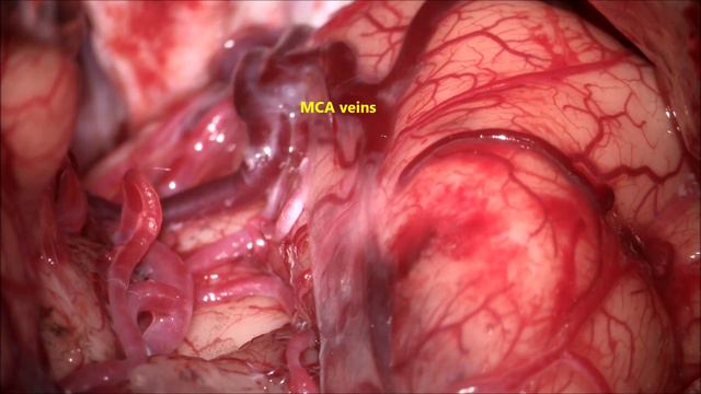 DEEP TEMPORAL GANGLIO-CAPSULAR GLIOMA-TRANS SYLVIAN FISSURE MICROSURGICAL REMOVAL-dr suresh dugani смотреть онлайн