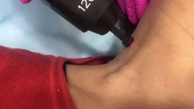 Лазерная шлифовка кожи смотреть онлайн