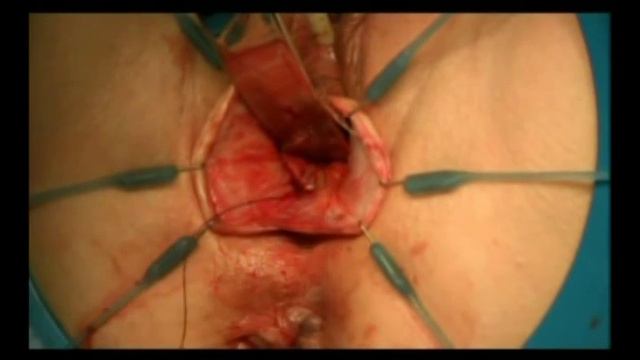 Элевейт Передний - Surgical смотреть онлайн