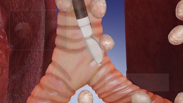 EBUS Procedure Overview-Olympus Bronchoscopy смотреть онлайн