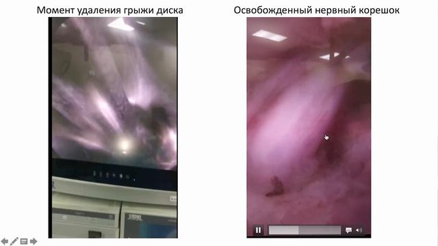 Эндоскопическое лечение грыжи диска позвоночника смотреть онлайн