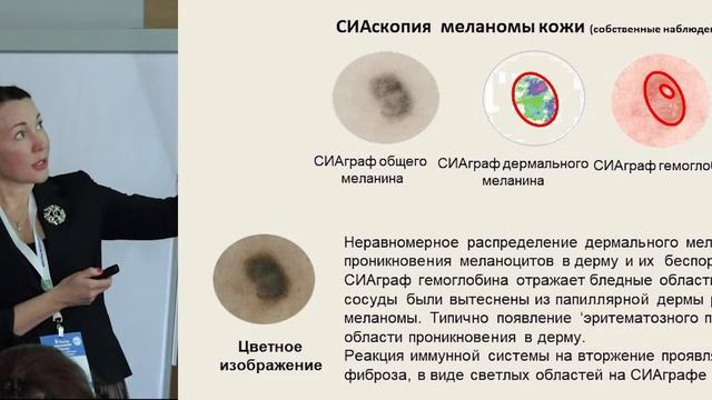 Взаимодействие служб – основа успеха ранней диагностики меланомы на примере.  Соколова А.В.