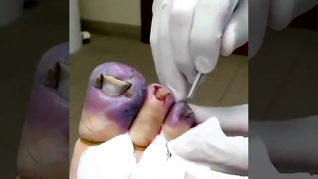 Удаление ногтевых пластинок смотреть онлайн