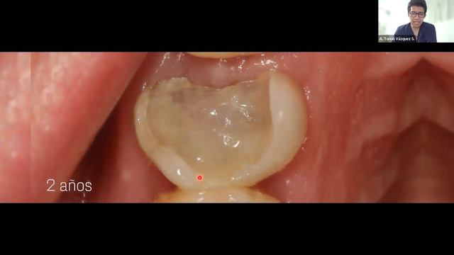 Restauraciones Biomimeticas con Bioactividad смотреть онлайн