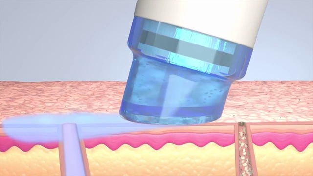 Косметологическая чистка лица HydraFacial MD смотреть онлайн