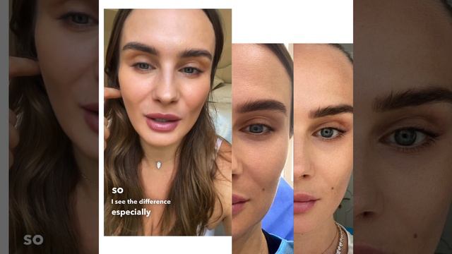 Non surgical facelift, incredible results after just one procedure,before/after speak for themselve смотреть онлайн