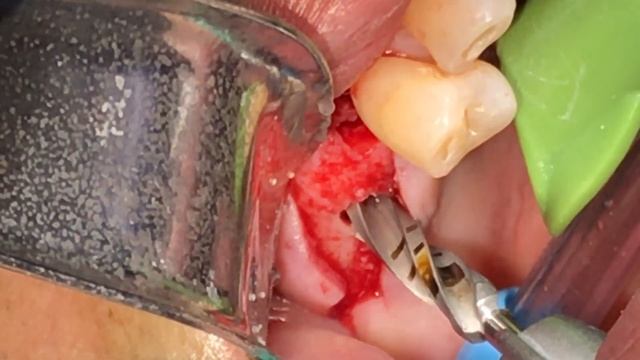Sinus Lift Straumann TL Implant Placement