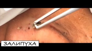 ПРЫЩИ ЗА УХОМ. ВЫДАВЛИВАНИЕ ЧЕРНЫХ ТОЧЕК. ПРЫЩИ - ХИРУРГИЯ. ВЫДАВЛИВАНИЕ ЧЕРНЫХ ТОЧЕК !!!