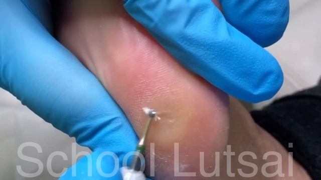 Обработка мозоли смотреть онлайн