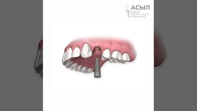 Какие этапы выключает в себя имплантация зуба? | Аманова Бота Сериккановна