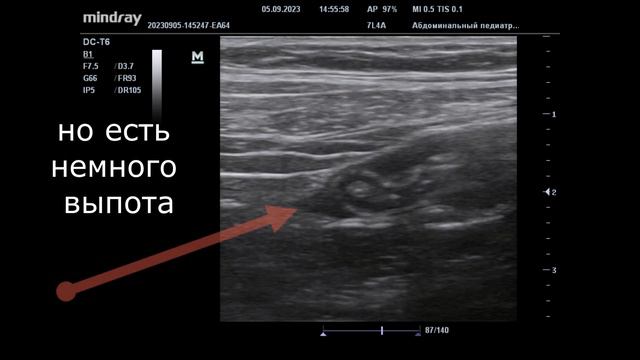 УЗИ ОБП. Катаральный аппендицит