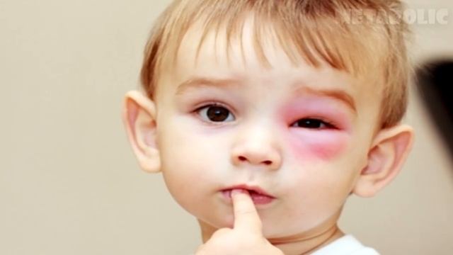 ЧТО ДЕЛАТЬ, ЕСЛИ УКУСИЛА ОСА? смотреть онлайн