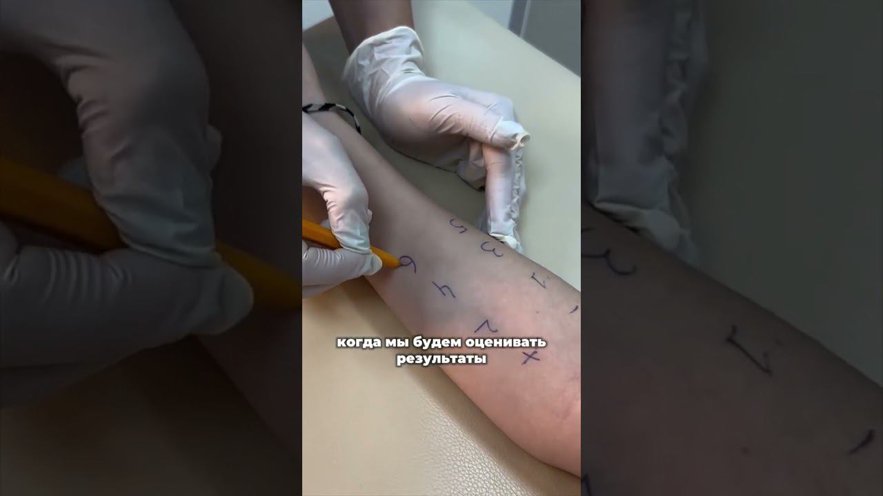 Как проверяют на аллергию в 2024 г. #аллергия #аллергодиагностика смотреть онлайн