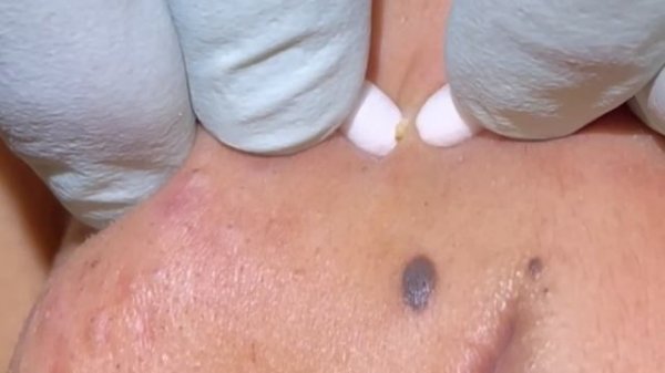 Blackheads for days part 1. 12 minutes of just the pop.acne extractions. Pimple popping.waxy plugs