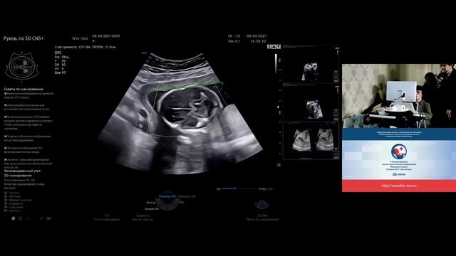 5D Heart - эхокардиография плода с интеллектуальной навигацией. Клинический обзор