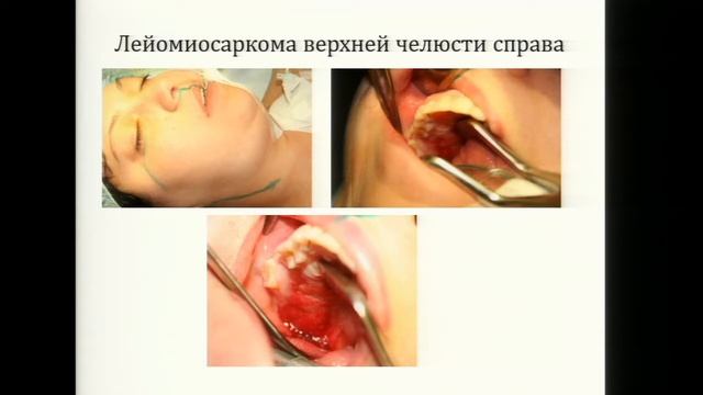 Чеботарев С.Я. Современные представления о реконструктивной хирургии средней трети лица смотреть онлайн