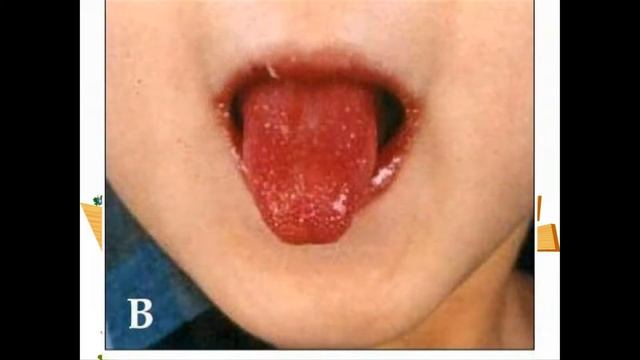 Bệnh Kawasaki ở trẻ: Nguyên nhân và cách điều trị смотреть онлайн