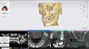 Изготовление хирургического шаблона Exo Cad + 3Shape