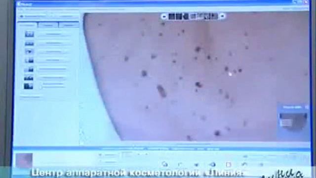 Лазер на парах меди, Харьков, Яхрома-Мед смотреть онлайн