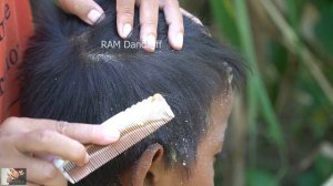 Psoriasis treatment, Dandruff Removal, Itchy Scratching, Huge Flakes, Part 296