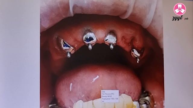 протезирование полным съёмным протезом с опорой на 4 зуба смотреть онлайн