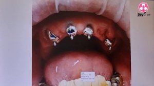 протезирование полным съёмным протезом с опорой на 4 зуба