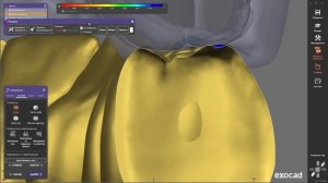 EXOCAD Изготовление прототипа для балочной конструкции All-on-4.