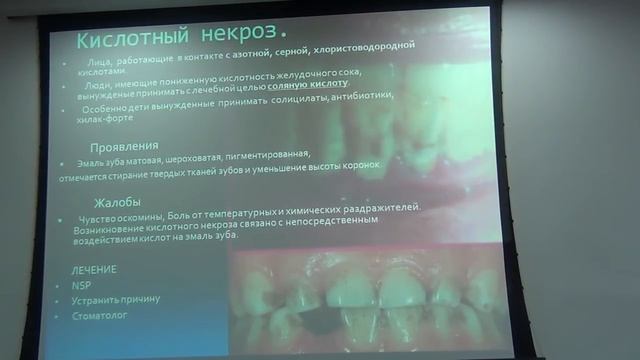 Некариозные заболевания зубов и органов полости рта. смотреть онлайн