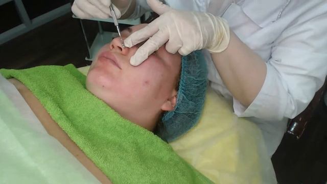 Механическая Чистка. Массаж по Жаке, Дарсонвализация