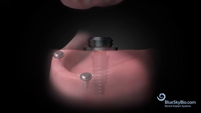 Overdenture Chairside Technique смотреть онлайн