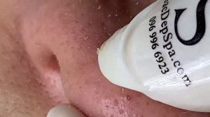 The best pimples popping- relaxing everyday 2